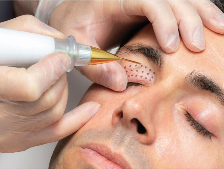 Imagem ilustrativa de blefaroplastia sem corte