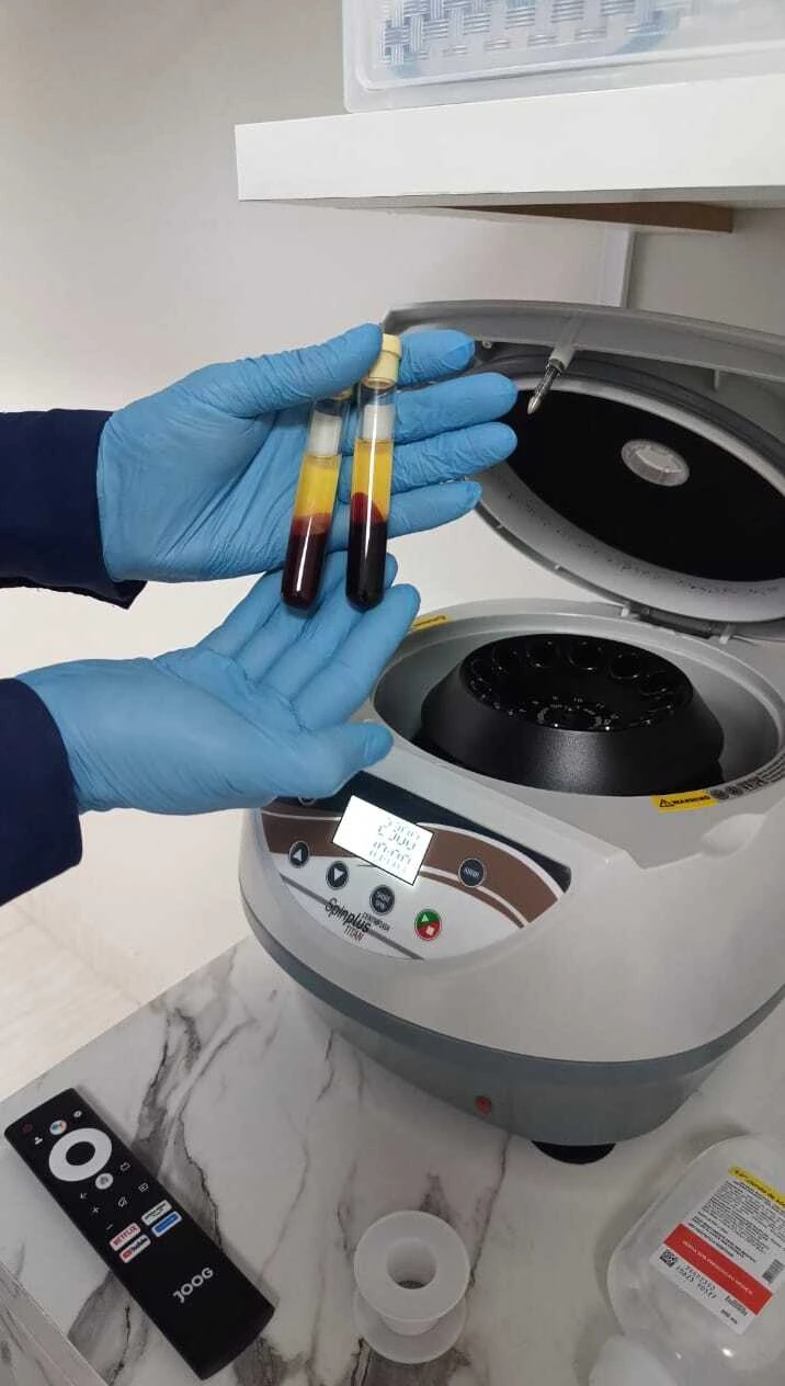 Imagem ilustrativa do tratamento PRP